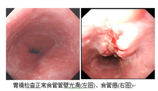 食管癌