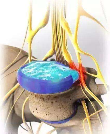 干細(xì)胞移植從這2方面修復(fù)改善椎間盤退變