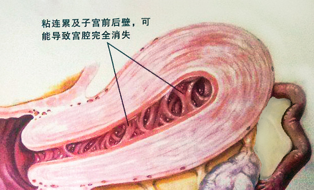 干細胞的4大作用，幫助修復宮腔粘連所致的子宮內(nèi)膜損傷