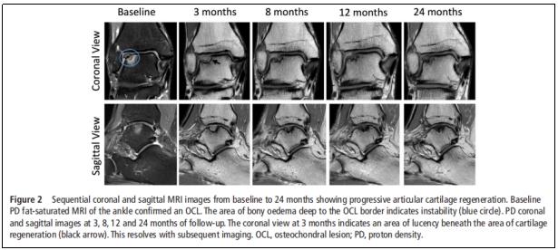 首次報道|干細(xì)胞治療踝關(guān)節(jié)軟骨損傷臨床試驗(yàn)