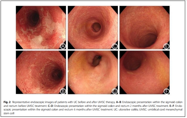UC-MSCs移植2個(gè)月，73.2%潰瘍性結(jié)腸炎患者達(dá)到臨床緩解，43.9%患者經(jīng)歷粘膜愈合！